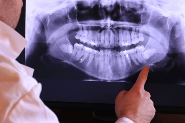 Best Emergency Tooth Extraction in Burlingame, CA
