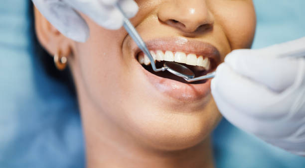 Best Emergency Root Canal Treatment in Burlingame, CA