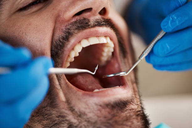 Best Emergency Broken Tooth Repair in Burlingame, CA
